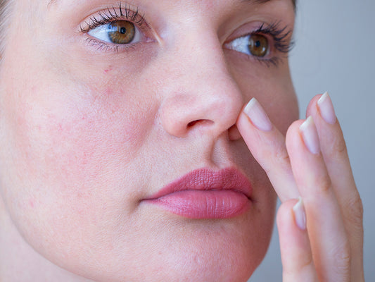 What is rosacea and why does sun protection matter?