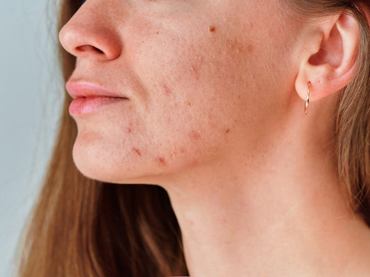 Second puberty? Why adult acne happens & how to treat it