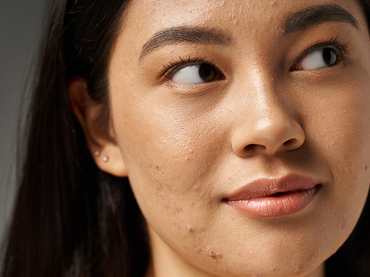 Top products & skin care options for spot prone skin