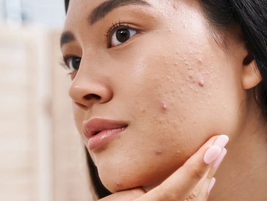 Understanding adult acne and hormonal breakouts