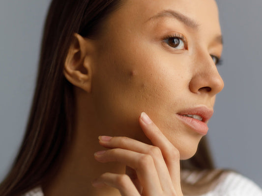 What type of acne do I have? A guide to mild, moderate and severe acne