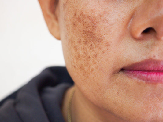 What is hyperpigmentation? Causes, types and why it happens