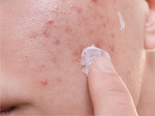 Skin barrier health and acne-prone skin: A guide to retinoid support
