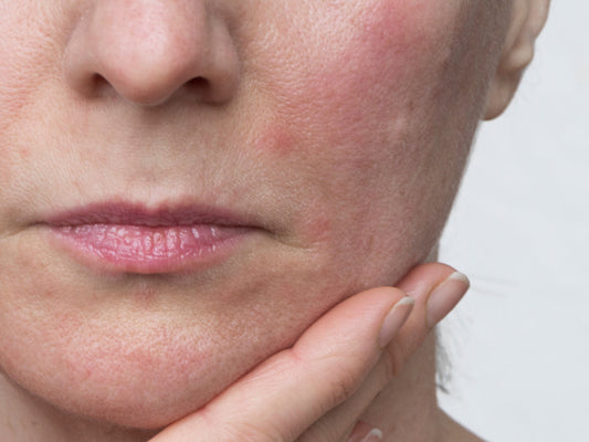 Retinoid side effects: What to expect and how to manage them