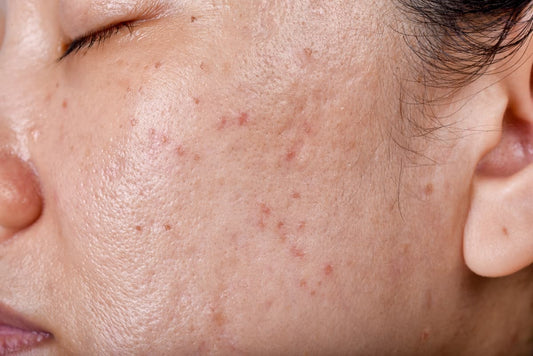 Beyond the blemishes: Real skin stories from people living with acne-prone skin