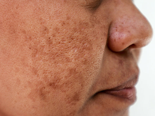 What causes hyperpigmentation & how to treat it effectively